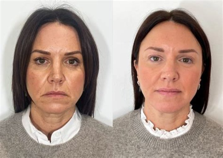 
Did Sarah Palin Have Face Lift Surgery? 