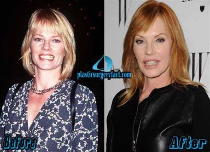 Marg Helgenberger Plastic Surgery Before and After