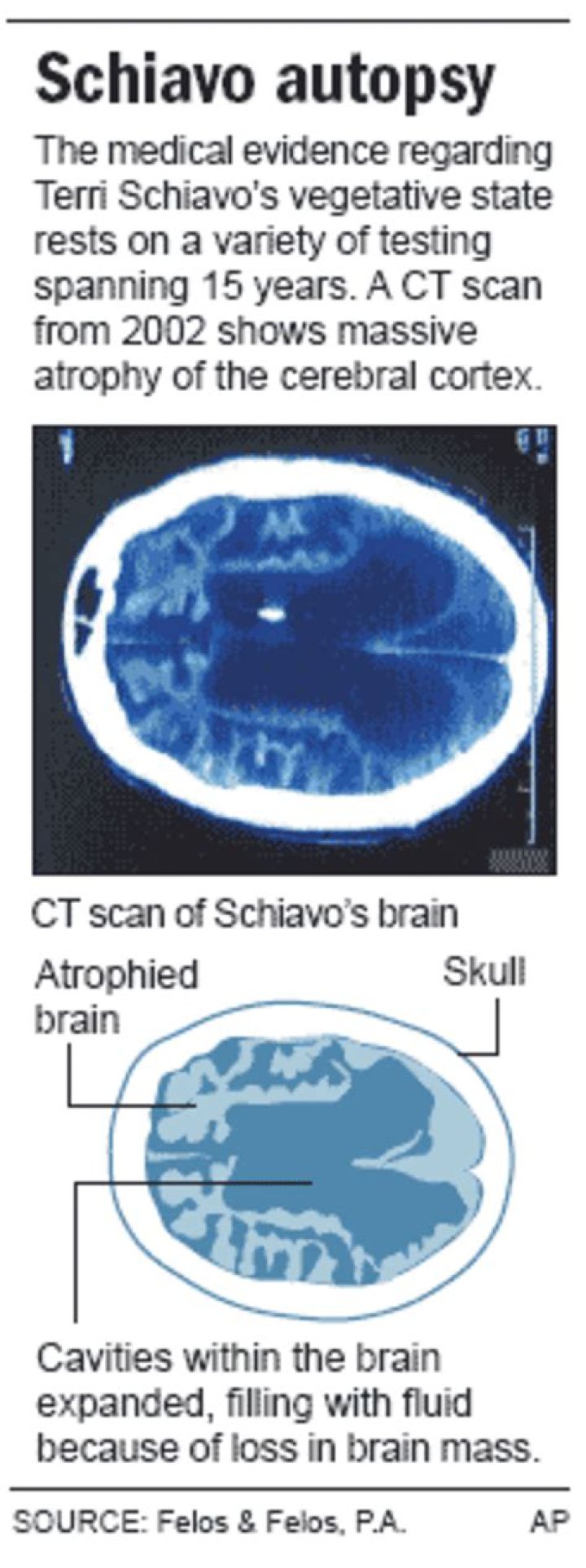 
Terri Schiavo’s Brain: What Happened? Details On The Autopsy And Documentary 