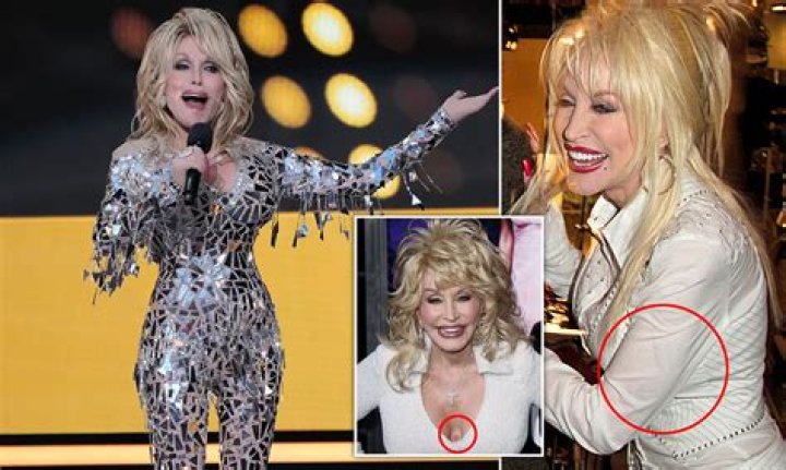 Why does Dolly Parton wear gloves on her hands? Why won't Dolly Parton show her arms?