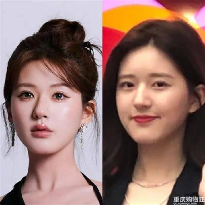 zhao lusi plastic surgery